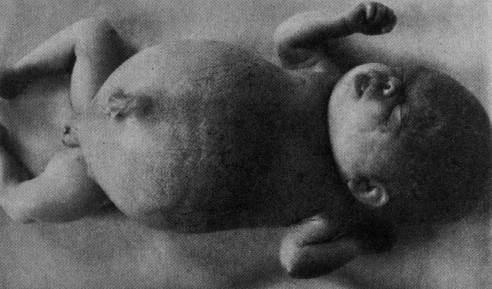 The image “http://www.neonatology.org/classics/hess1922/figures/fig176.gif” cannot be displayed, because it contains errors.